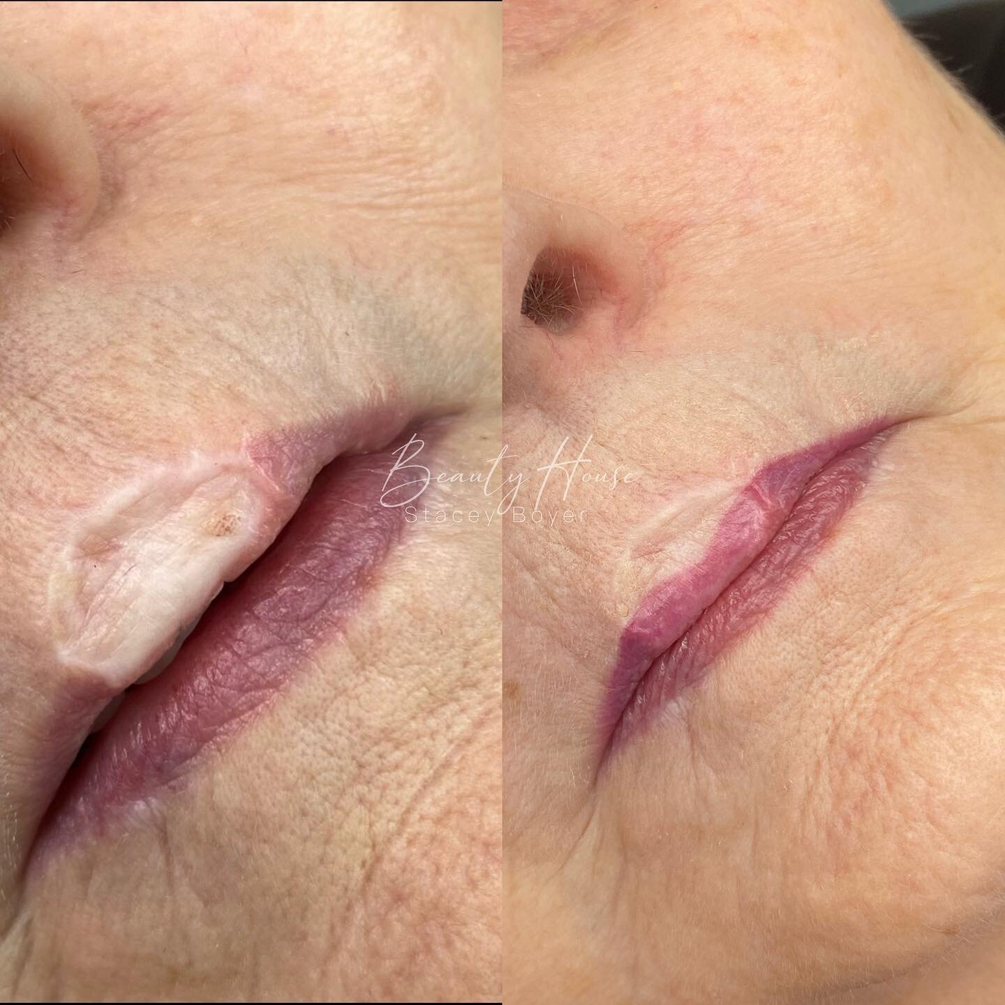This lovely client had a skin cancer removed on her upper lip that required a skin graft and as you can see took her vermilion border away.
This is healed after 4 sessions. This is why I love my job so much. So rewarding 💕
&bull;
&bull;
&bull;
&bull