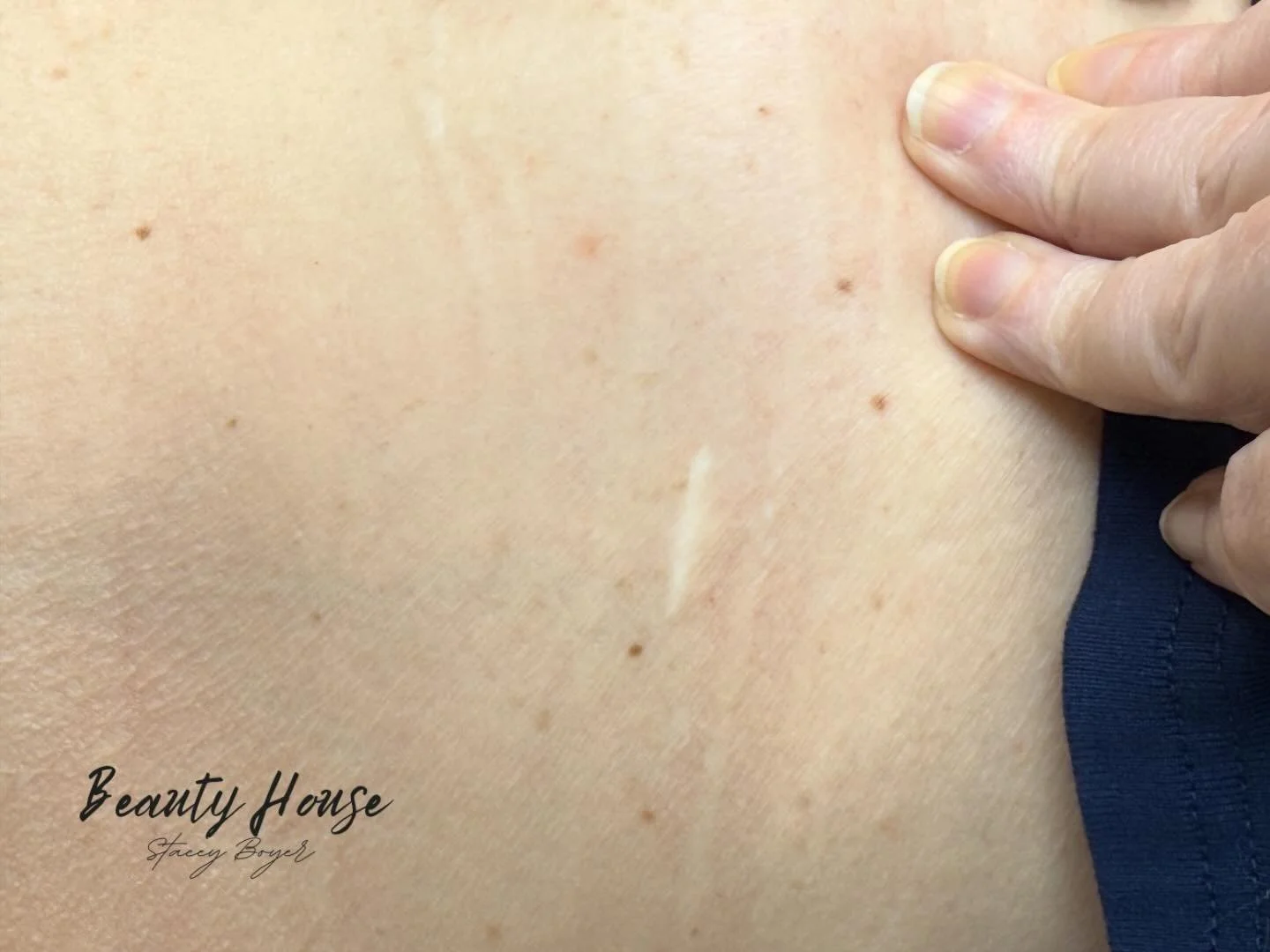 Before ➡️ After ✨ Scar Camo at Beauty House

This transformation speaks for itself. Scar camo is designed to blend and soften the appearance of scars for a more even, natural look.

✨ Important note: Redness immediately after treatment is completely 