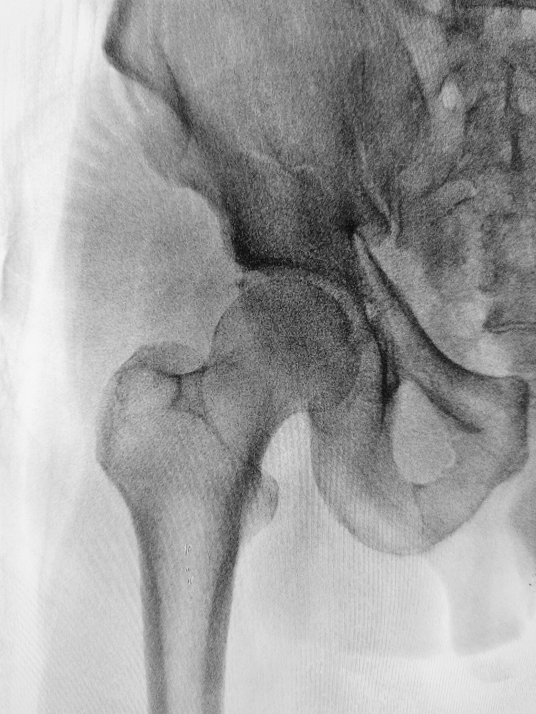Osteoporosis