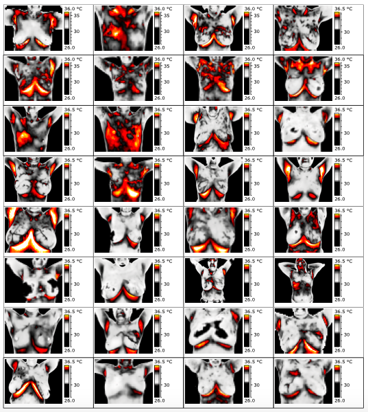Inteligência Artificial aliada na redução de filas para mamografia.