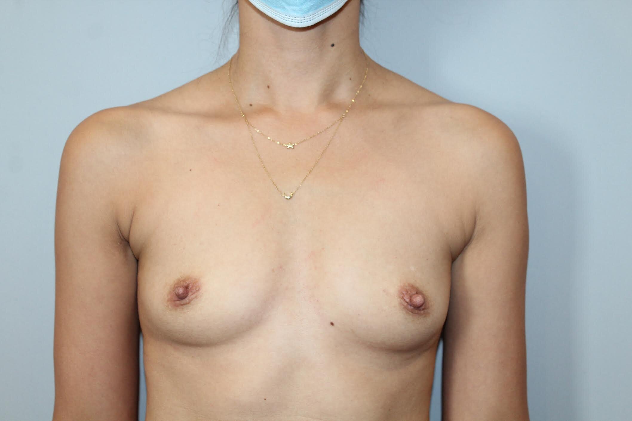 Before breast augmentation.jpeg