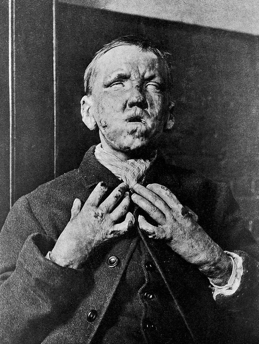 The Story of Hansen’s Disease (Leprosy): The Biblical “Curse of God ...