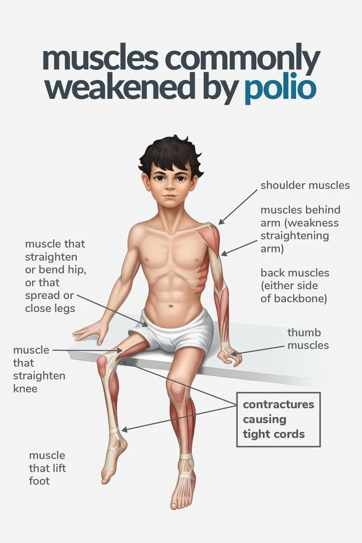 muscles commonly weakened by polio