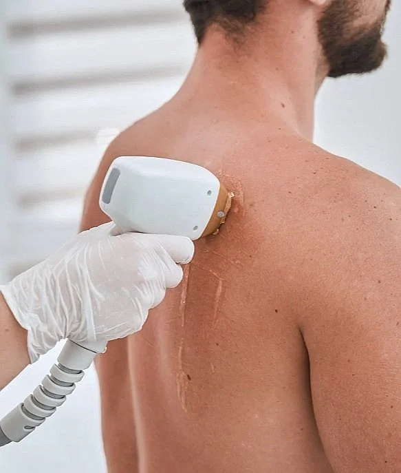 Person receiving laser hair removal on shoulder