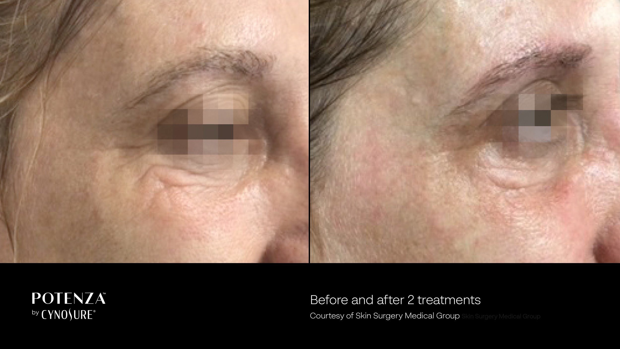 Before and after 2 Potenza RF microneedling treatments showing reduced fine lines around the eyes