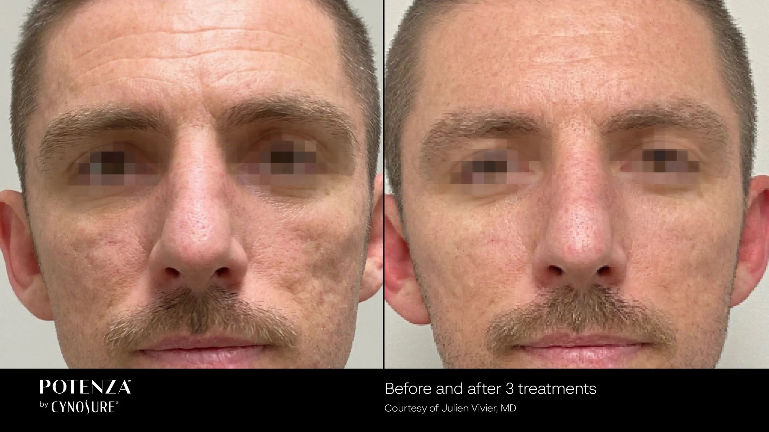 Before and after 3 Potenza RF microneedling treatments showing overall improved skin clarity and tone