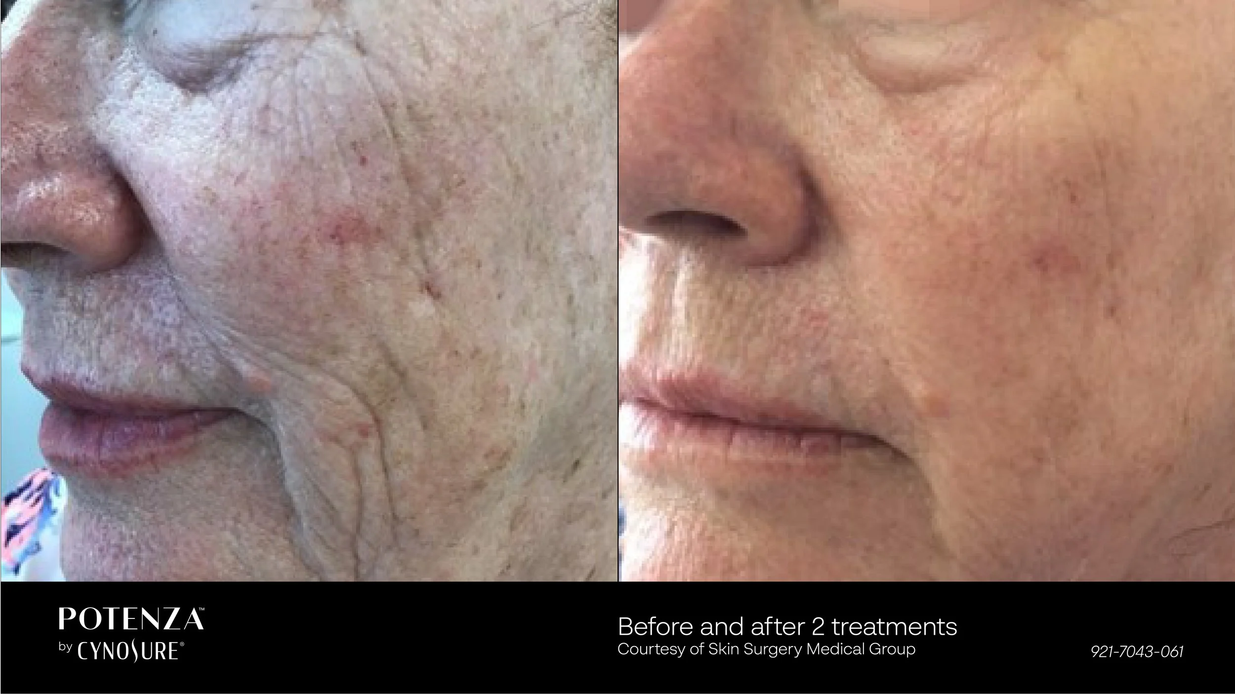 Before and after 2 Potenza RF microneedling treatments showing reduced pigmentation and clearer skin