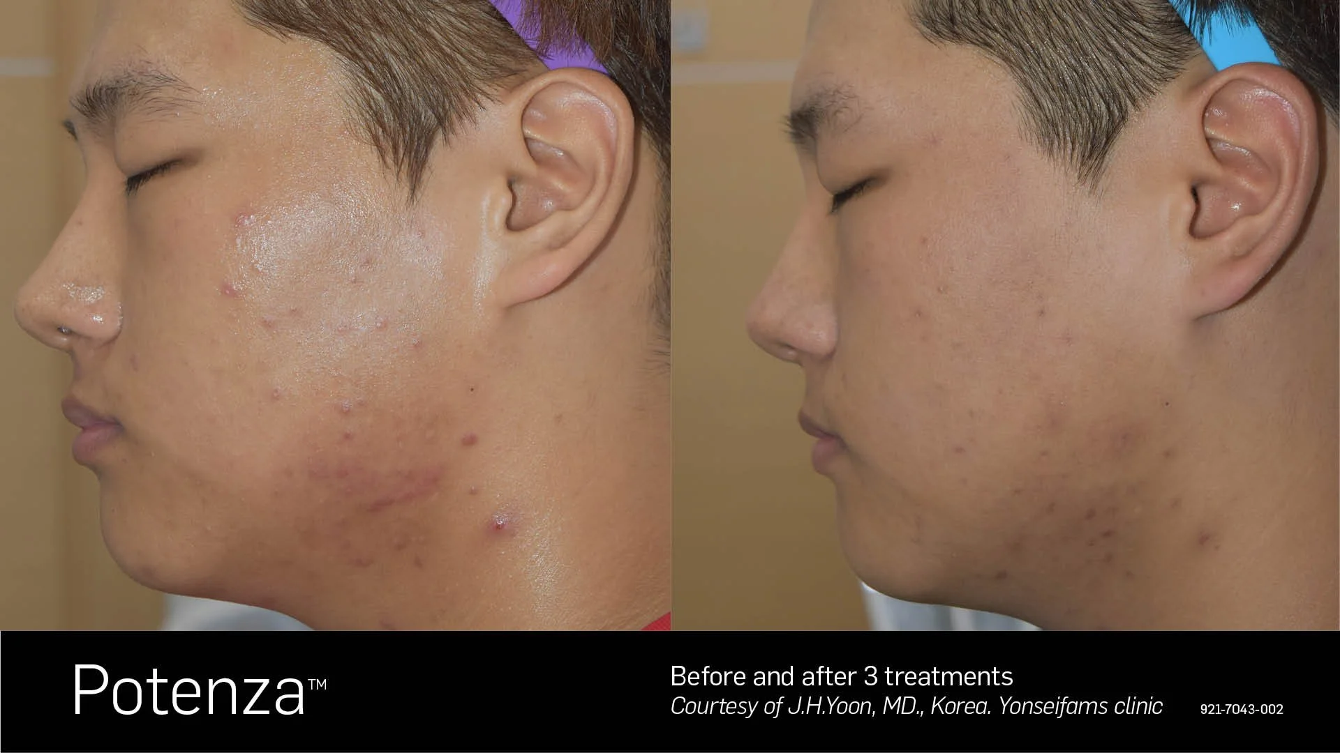 Before and after 3 Potenza RF microneedling treatments showing smoother skin texture and fewer acne marks