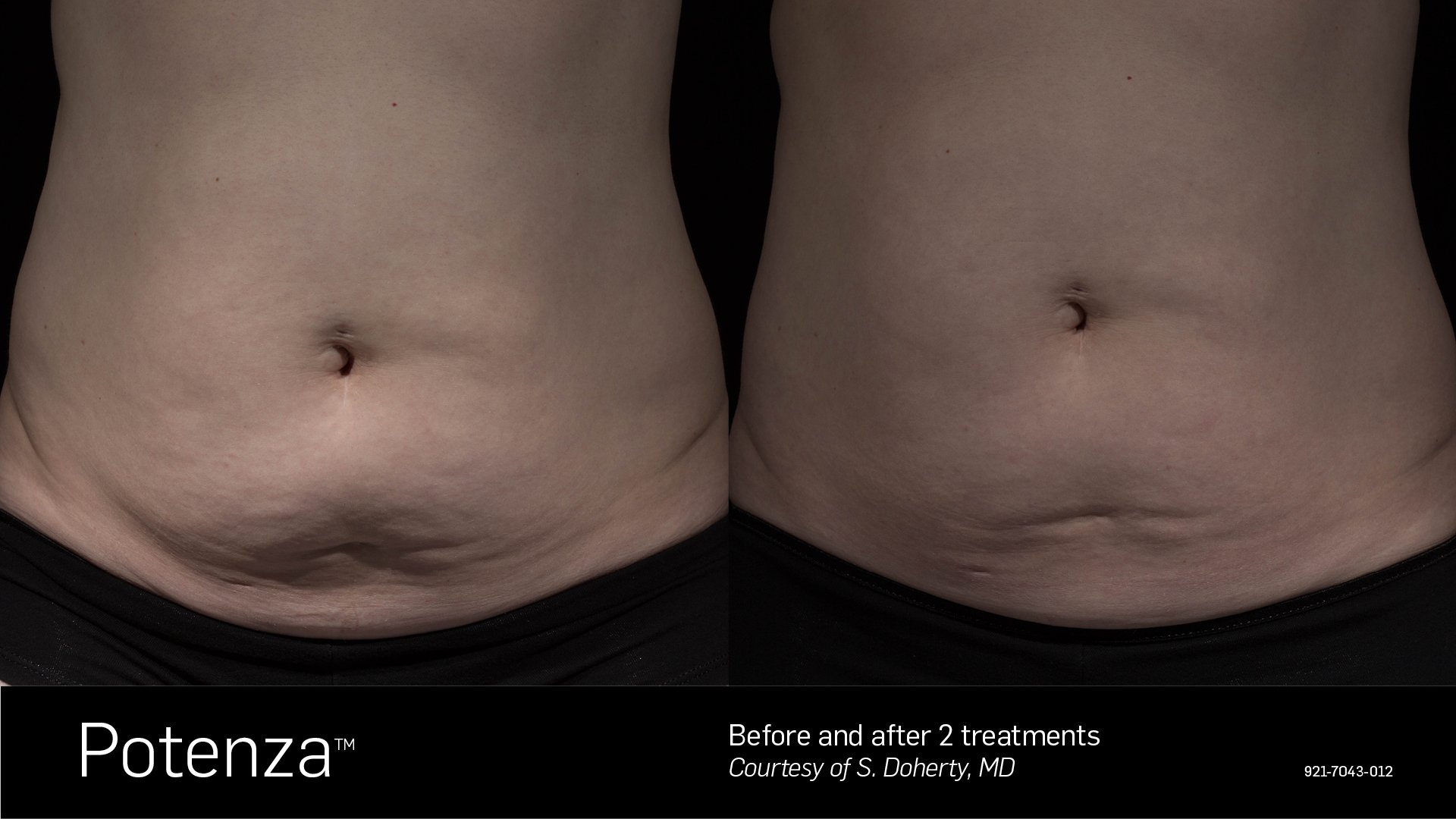 Before and after 2 Potenza RF microneedling treatments showing tighter, firmer abdominal skin