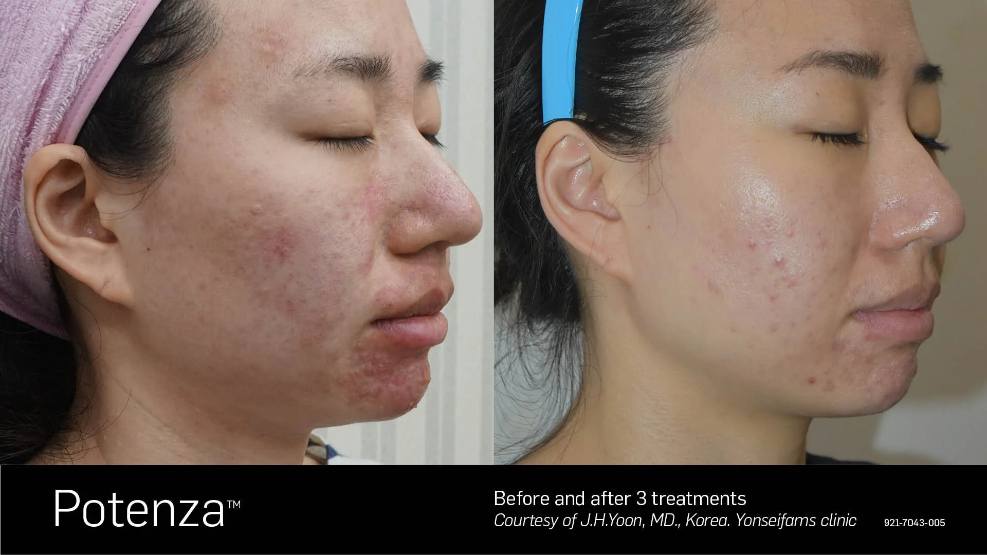 Before and after 3 Potenza RF microneedling treatments showing significantly reduced acne scarring