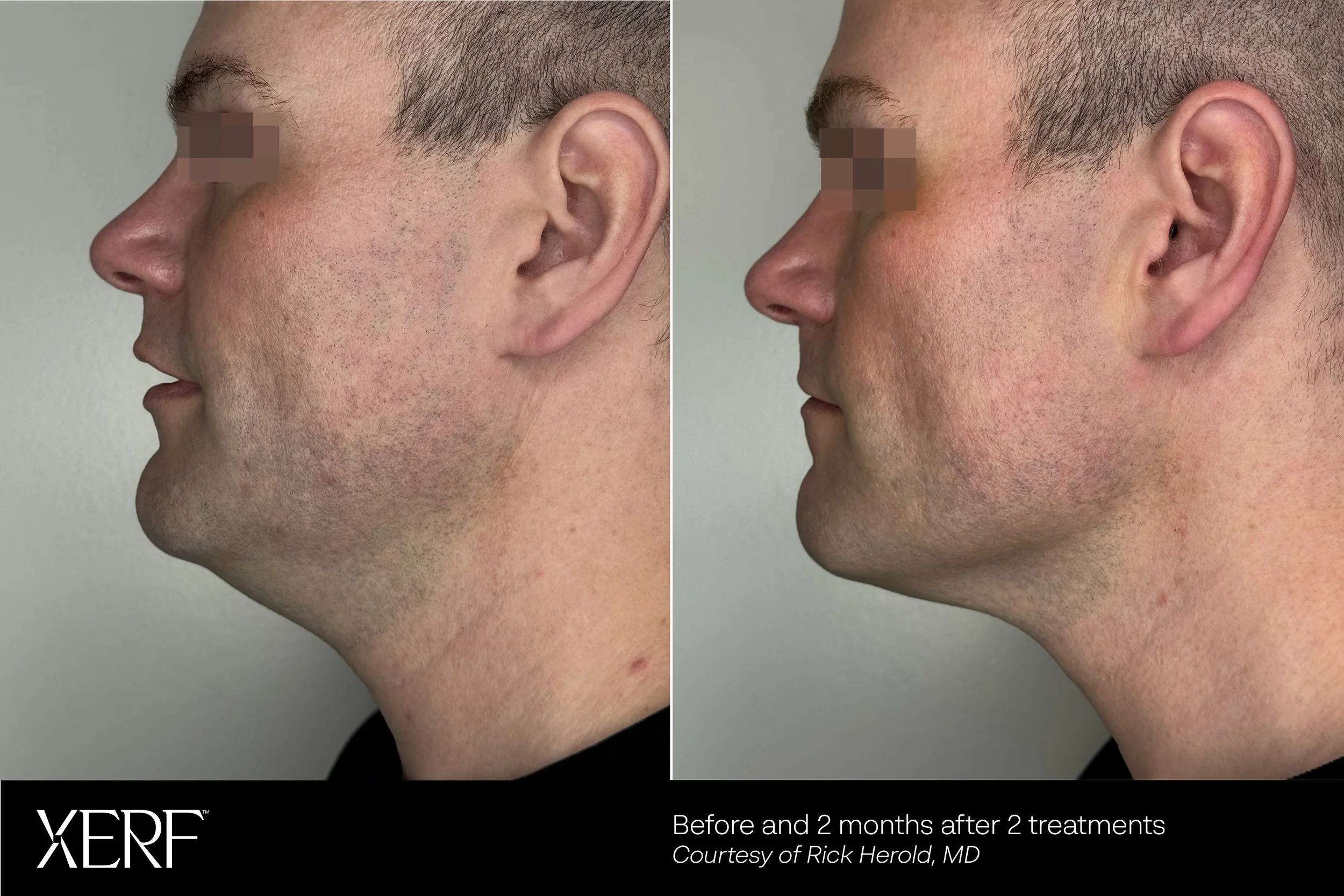 Before and after 2 Potenza RF microneedling treatments showing reduced redness and smoother jawline skin