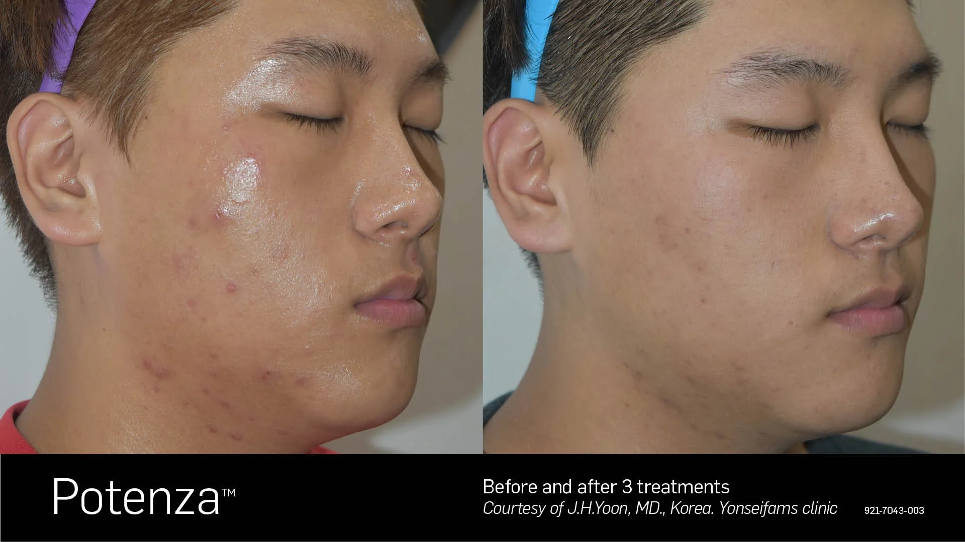 Before and after 3 Potenza RF microneedling treatments showing clearer complexion and reduced acne scars