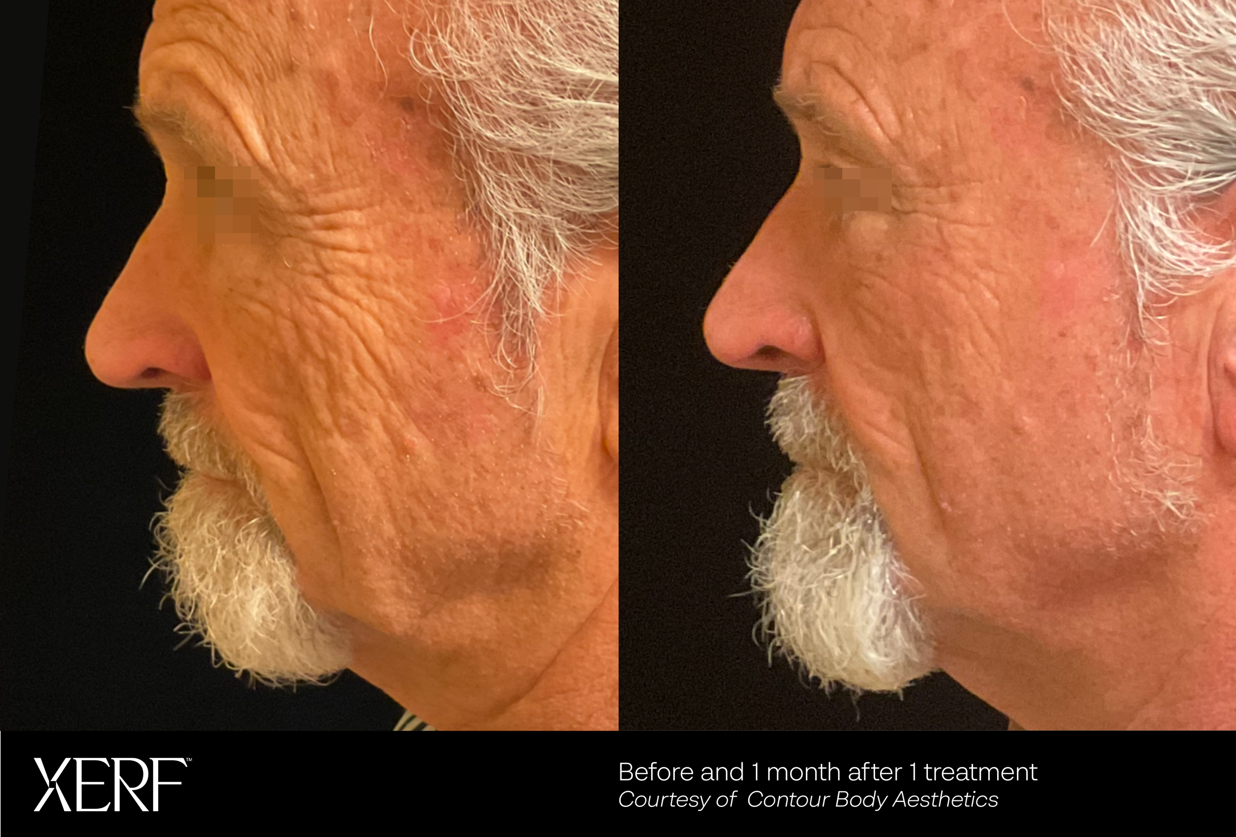 Before and after Potenza RF microneedling showing reduced facial wrinkles and tighter jawline skin
