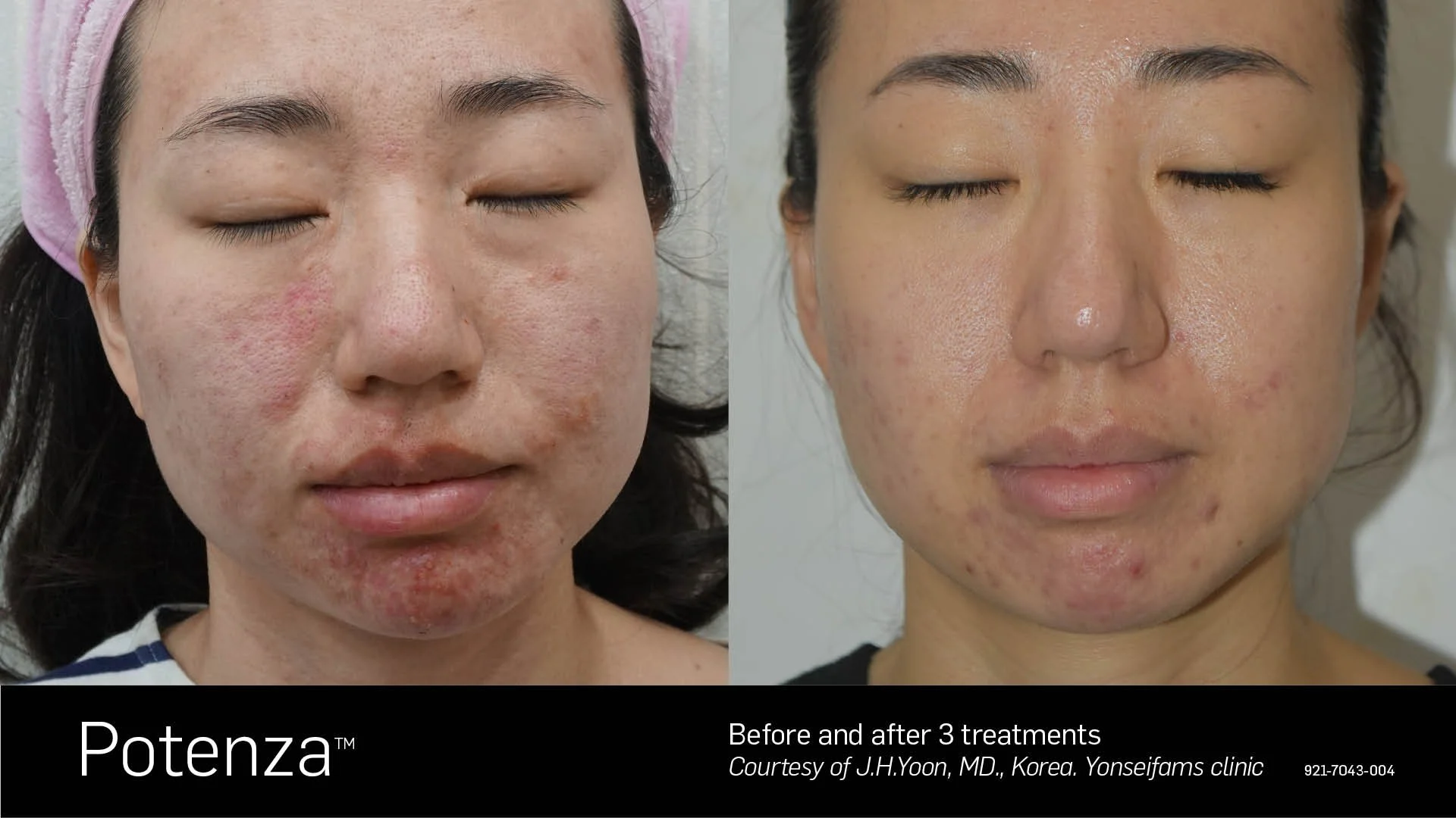 Before and after 3 Potenza RF microneedling treatments showing improved acne scars and skin texture