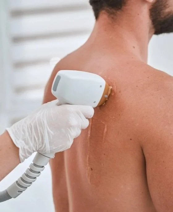 A person receiving laser hair removal treatment on their back.