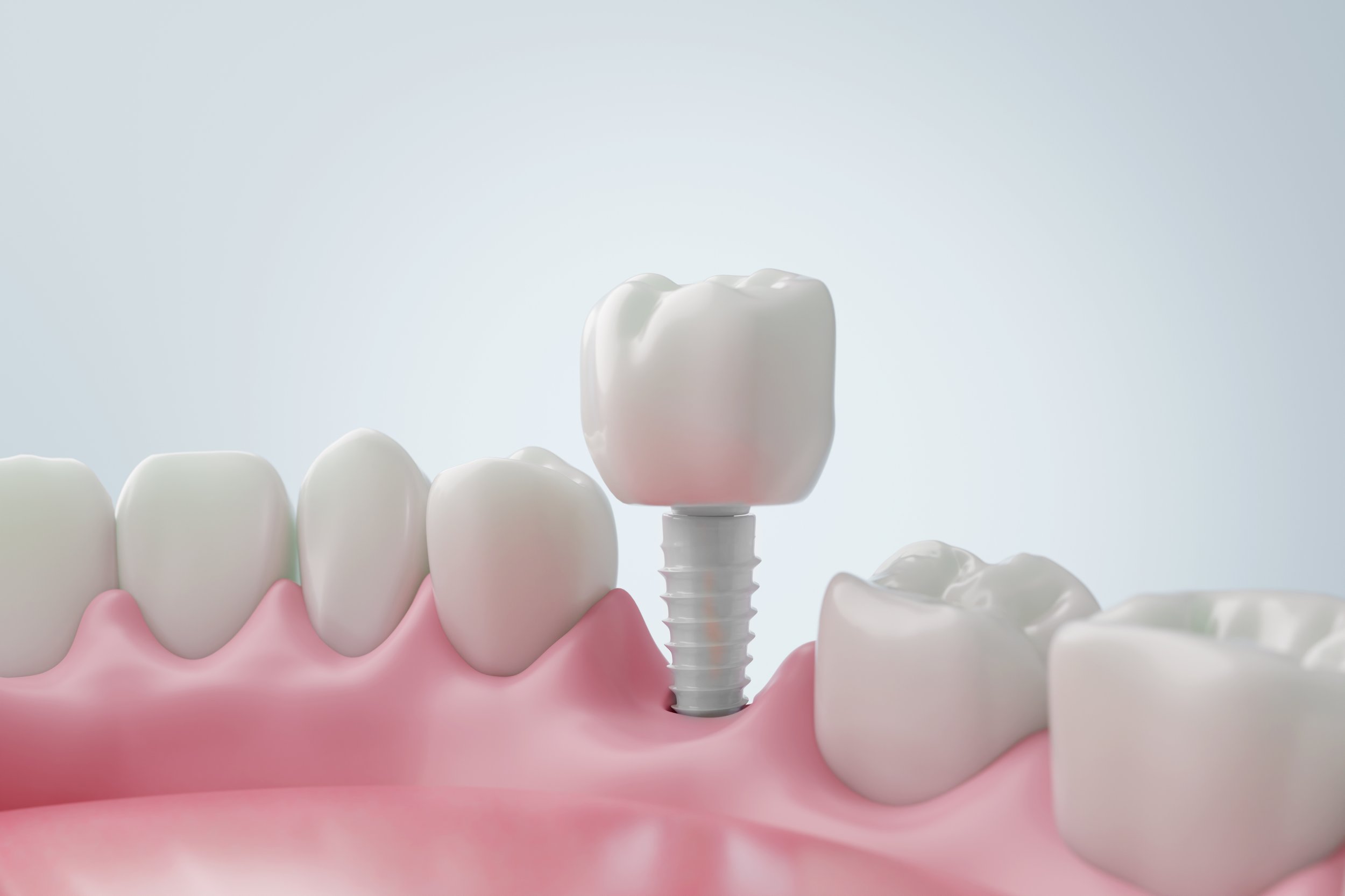Dental Implants