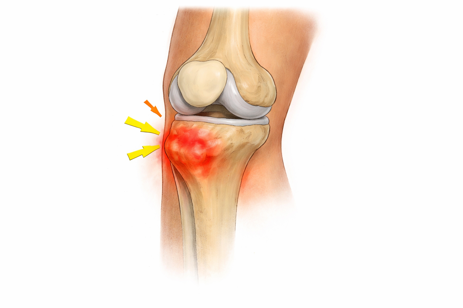 Osgood schlatter