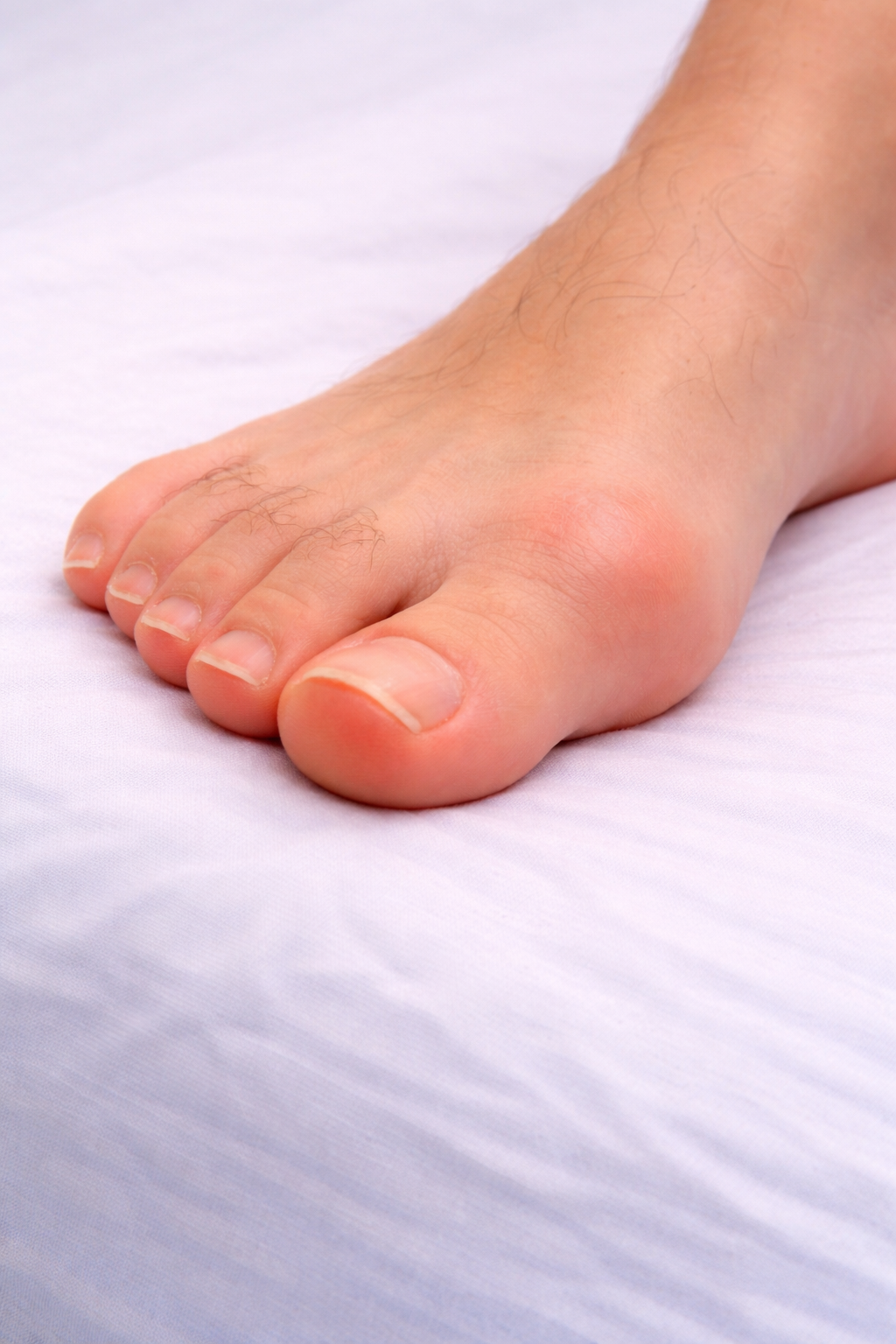 Hallux limitus / rigidus - Verstijving grote teen