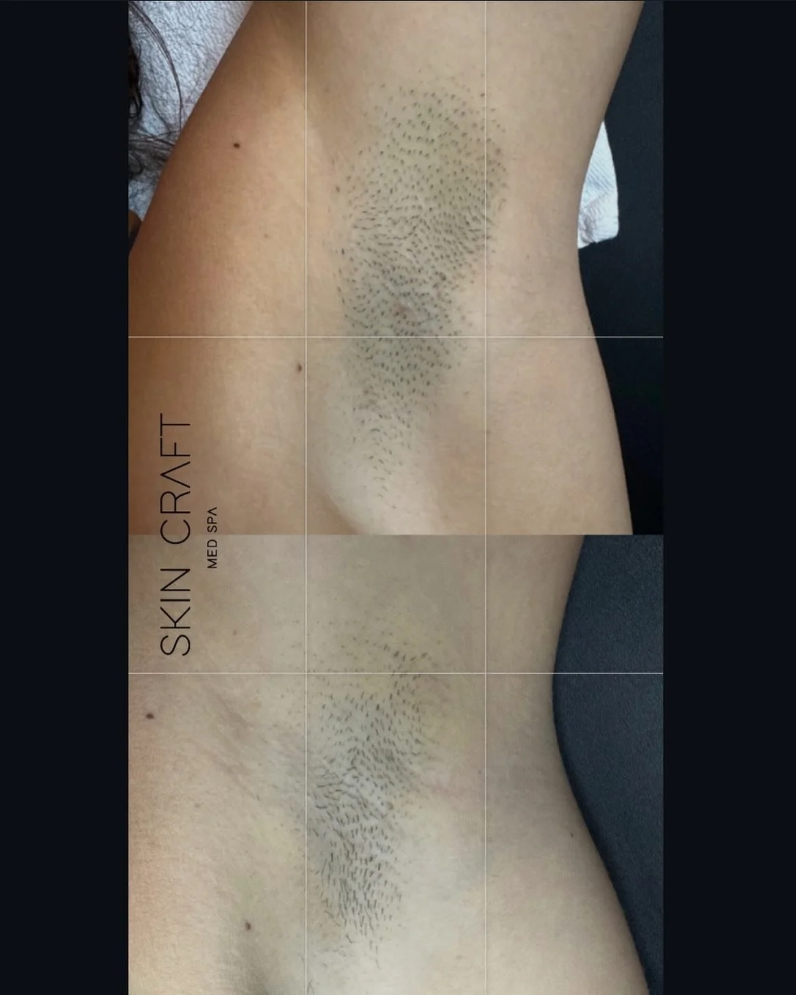 Laser hair removal journey, two treatments in and making some solid progress already!
1st treatment (top). 2nd treatment (bottom) 
&bull;
Underarms typically take 5-7 sessions for completion. All I ask of you is consistency, and you can sit back and 