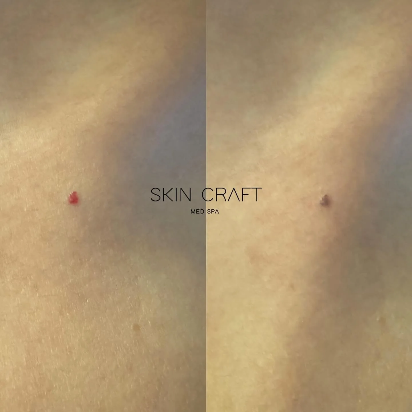 C H E R R Y  A N G I O M A 💥 
&bull;&bull;
I&rsquo;m obsessed with blasting these away. The likelihood of me trying to talk you into letting me remove them for you is reeeallllly high if I see them 😬
&bull;&bull;
Left picture is how the client show