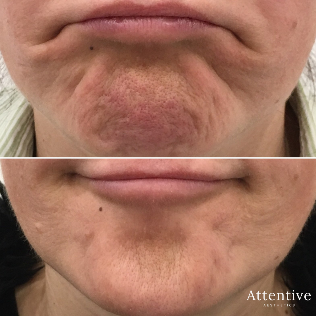 Chin Enhancement Anti Wrinkle Injections Perth Wrinkle Relaxers