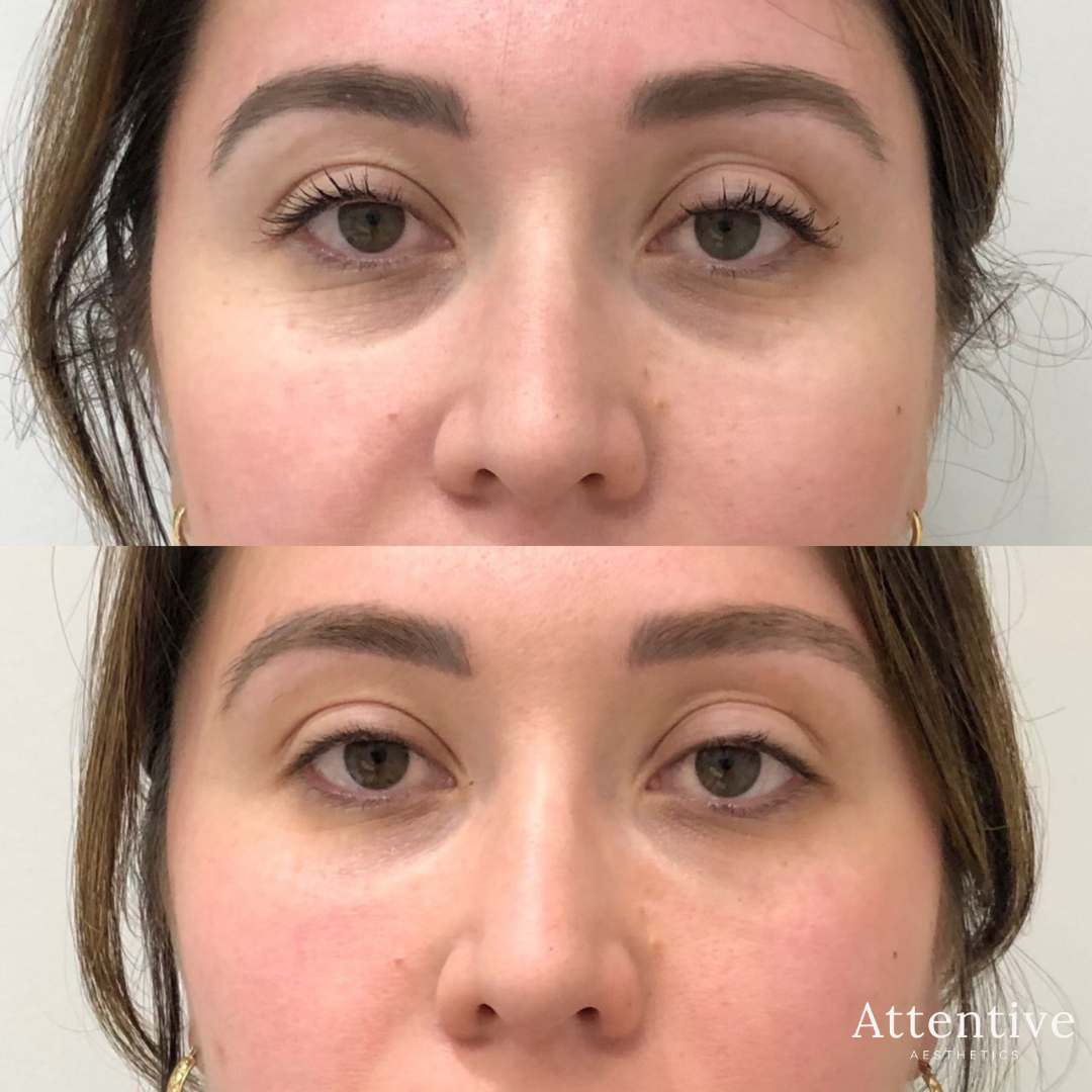 Under Eye Fillers Perth Tear Trough Filler Perth Attentive