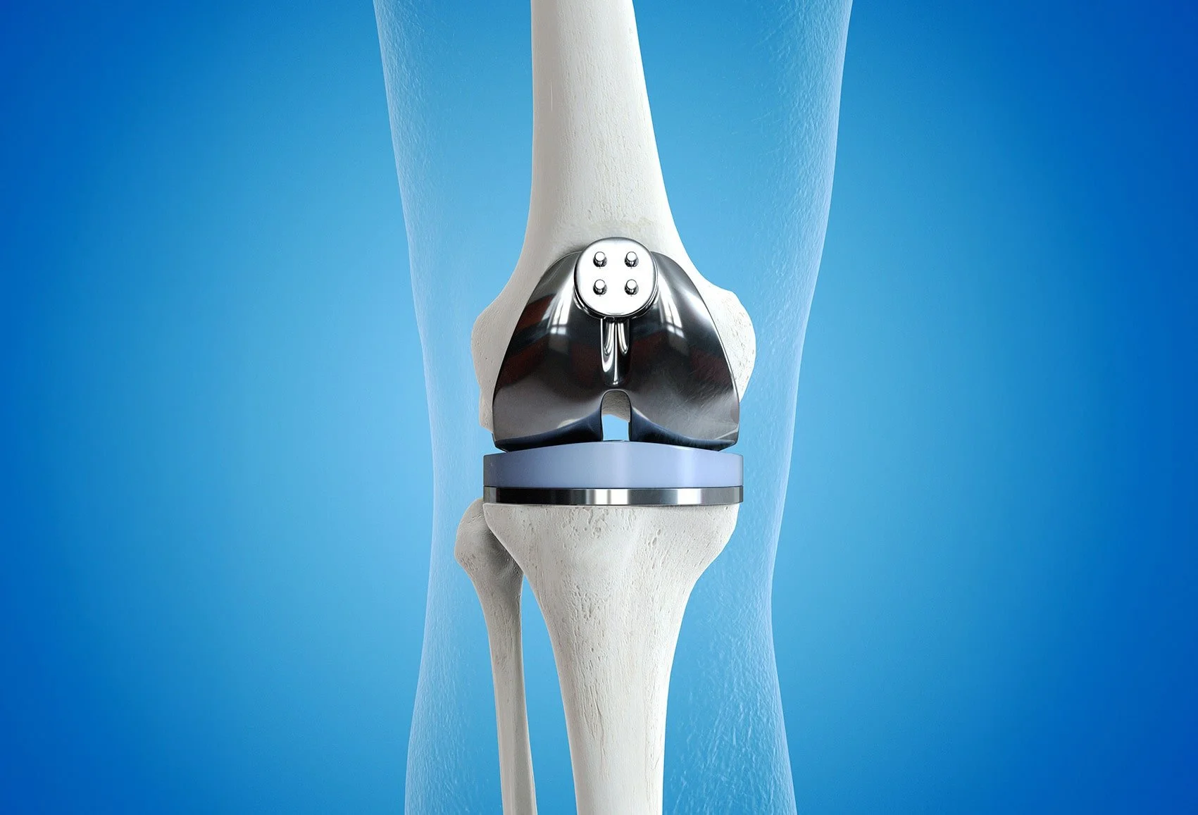 Total Knee Replacement Surgery Melbourne - Dr. David Sime
