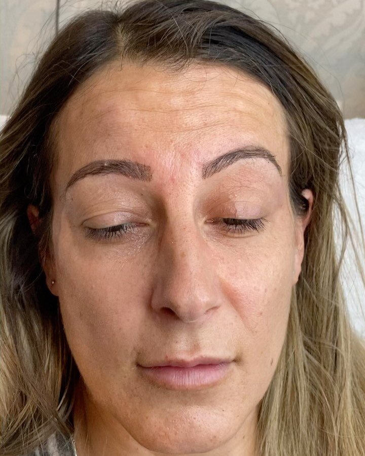 Anti wrinkle injections &hellip;..

1st video - before treatment 
2nd video - 5 days post treatment 

Anti wrinkle Injections continue to work for a maximum of 14 days. 

Look at the results movement/pull of the muscles but also the reduction in wrin