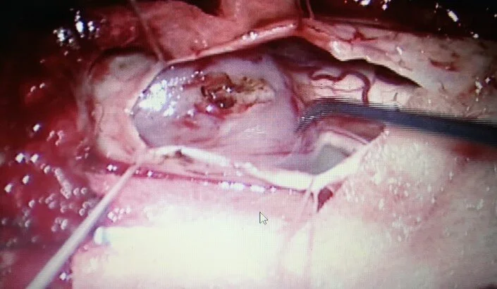 Figure 35. Tumour - intraoperative picture.jpg