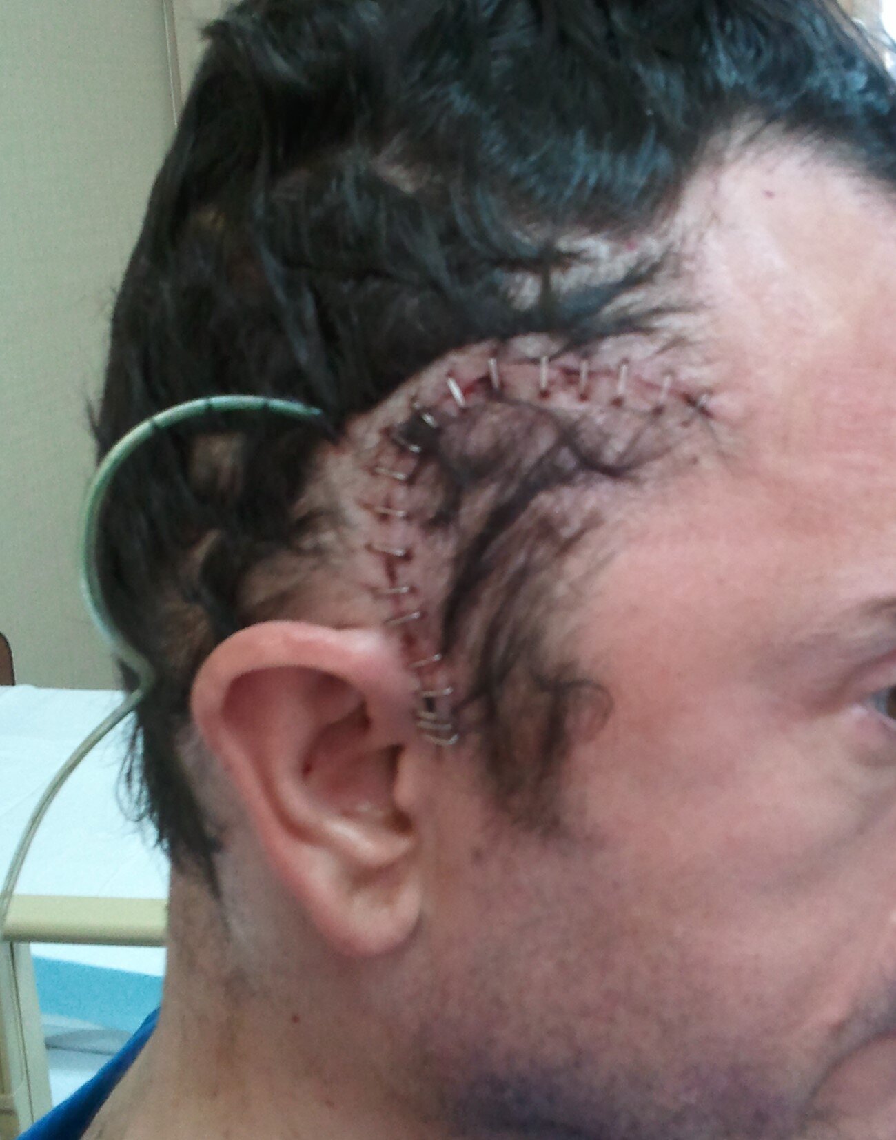 Craniotomy wound (small).jpg