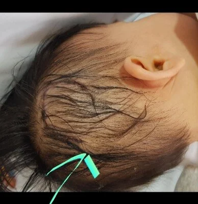 Figure 10. Post-op Craniotomy wound cavernoma.jpg