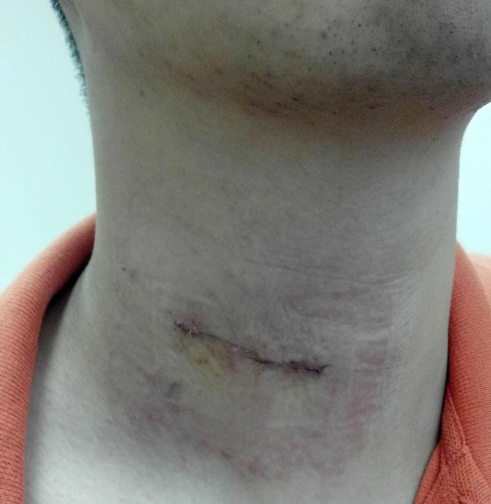 Figure 16. Post-op cervical surgery scar.jpg