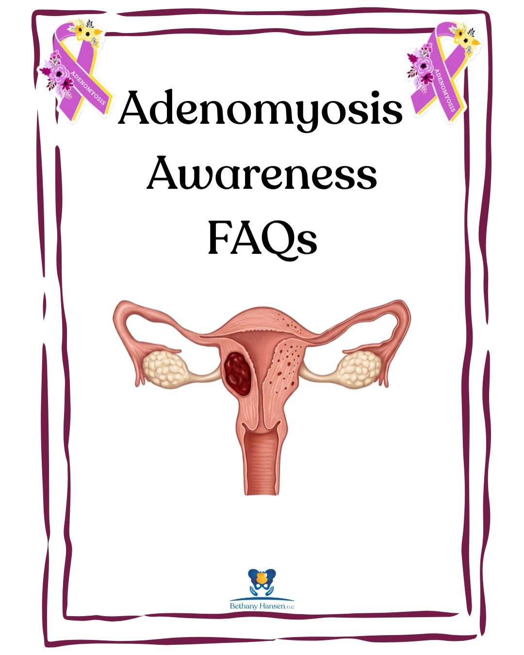 💗Adenomyosis Awareness Month💗

Adenomyosis is a disease of the uterus that is associated with painful periods, chronic pelvic pain, abnormal menstrual bleeding, infertility, and often coexists with endometriosis.

Pelvic floor physical therapy, in 