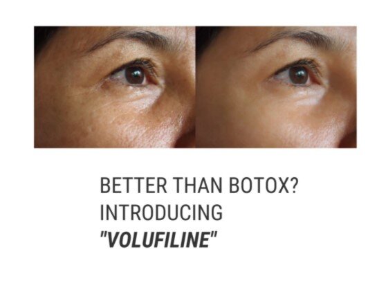 Volufiline vs. Botox