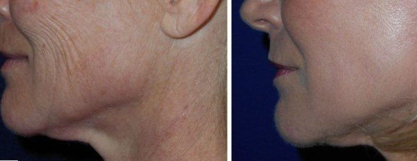 RESULTS FROM A PROFESSIONAL COLD PLASMA TREATMENT