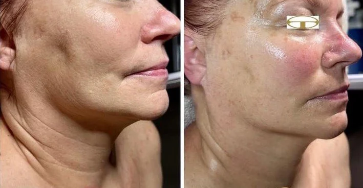 Device for reducing sagging jawline at home