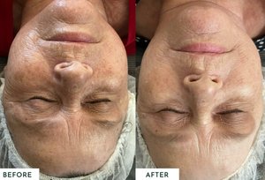 At-home device results before and after lines and wrinkles reduction