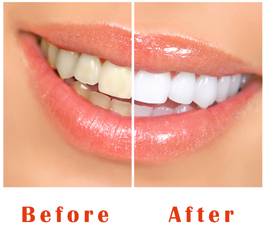 teeth-treatment-before-after.png