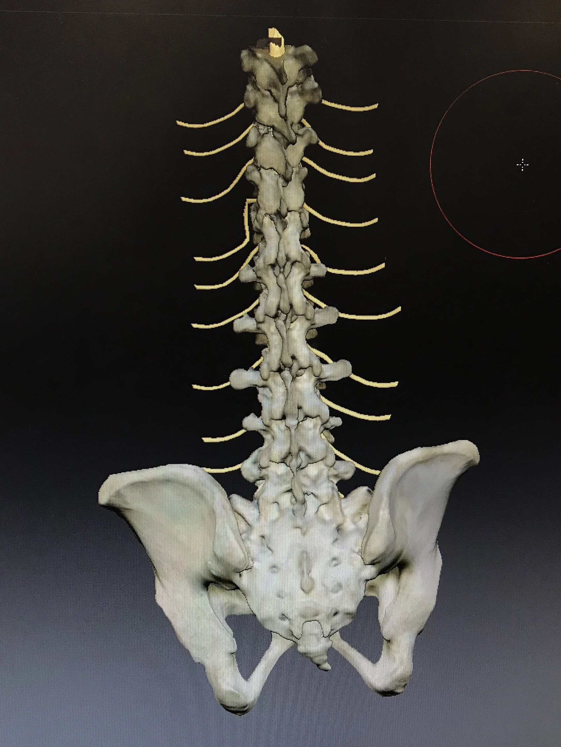 Lumbar spine including innervation, made with 3D spider scanner, Zbrush, and photoshop