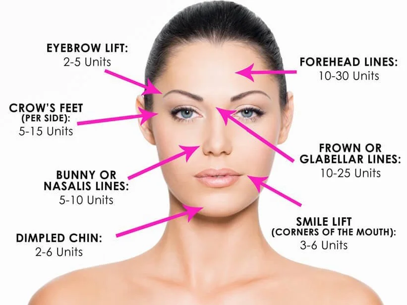 botox-face-diagram.jpeg