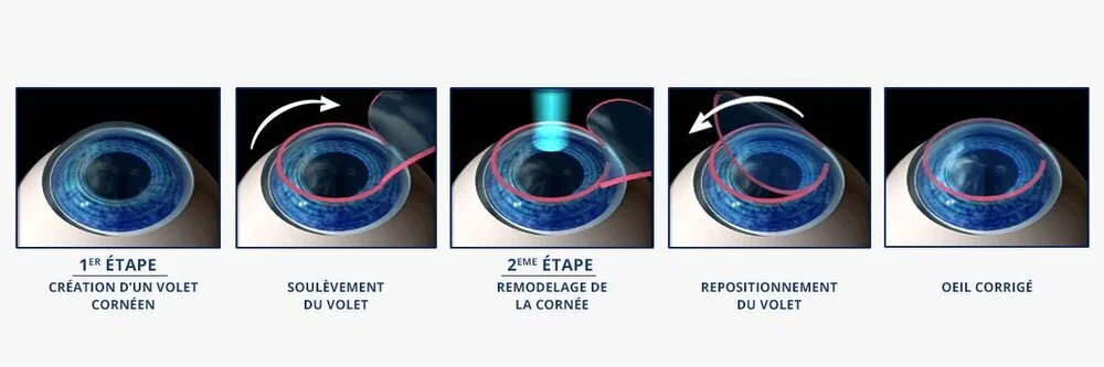 lasik+capot+chirurgie+refractive+laser+myopie.jpeg