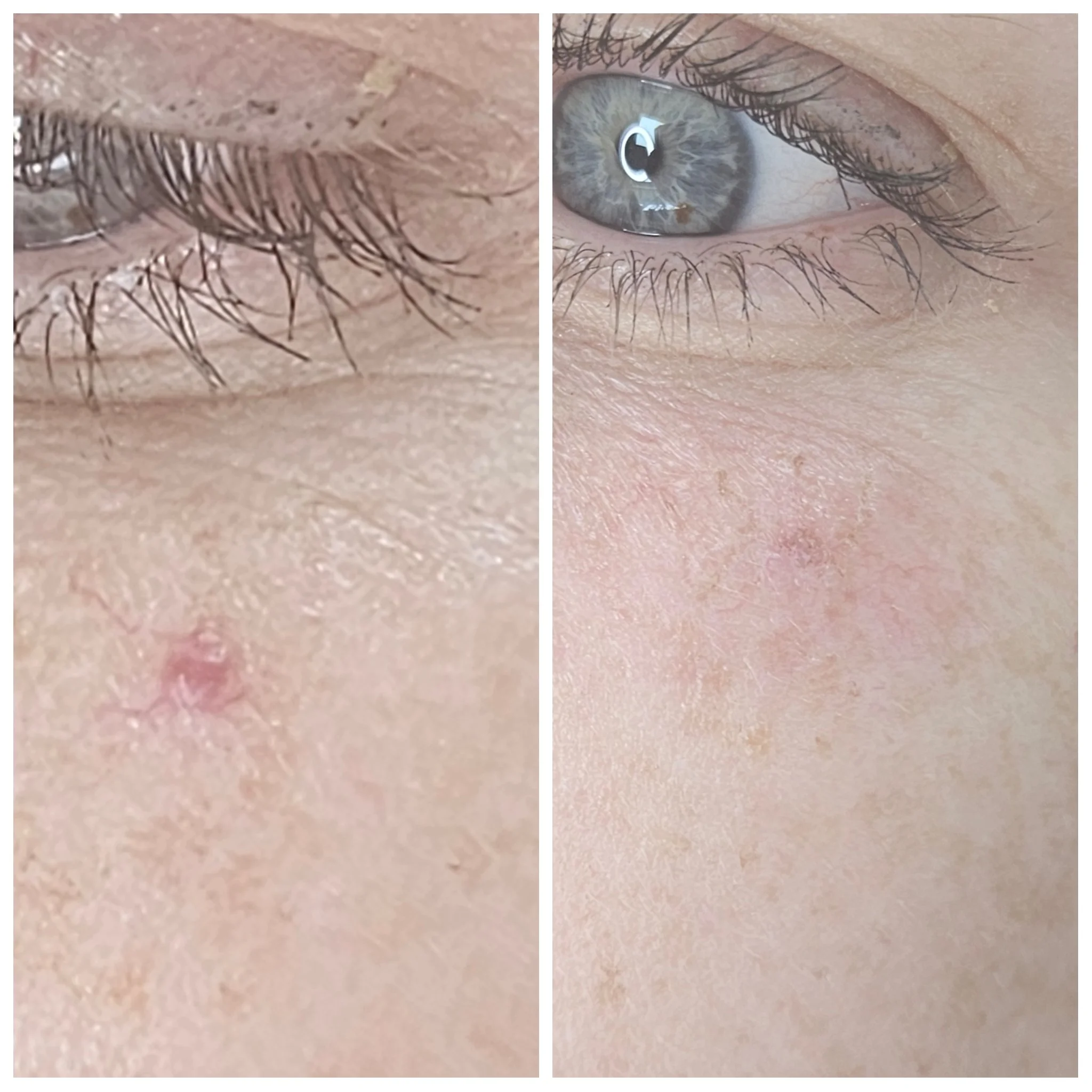Before and After image of a blood spot/vascular blemish treated with thermavein