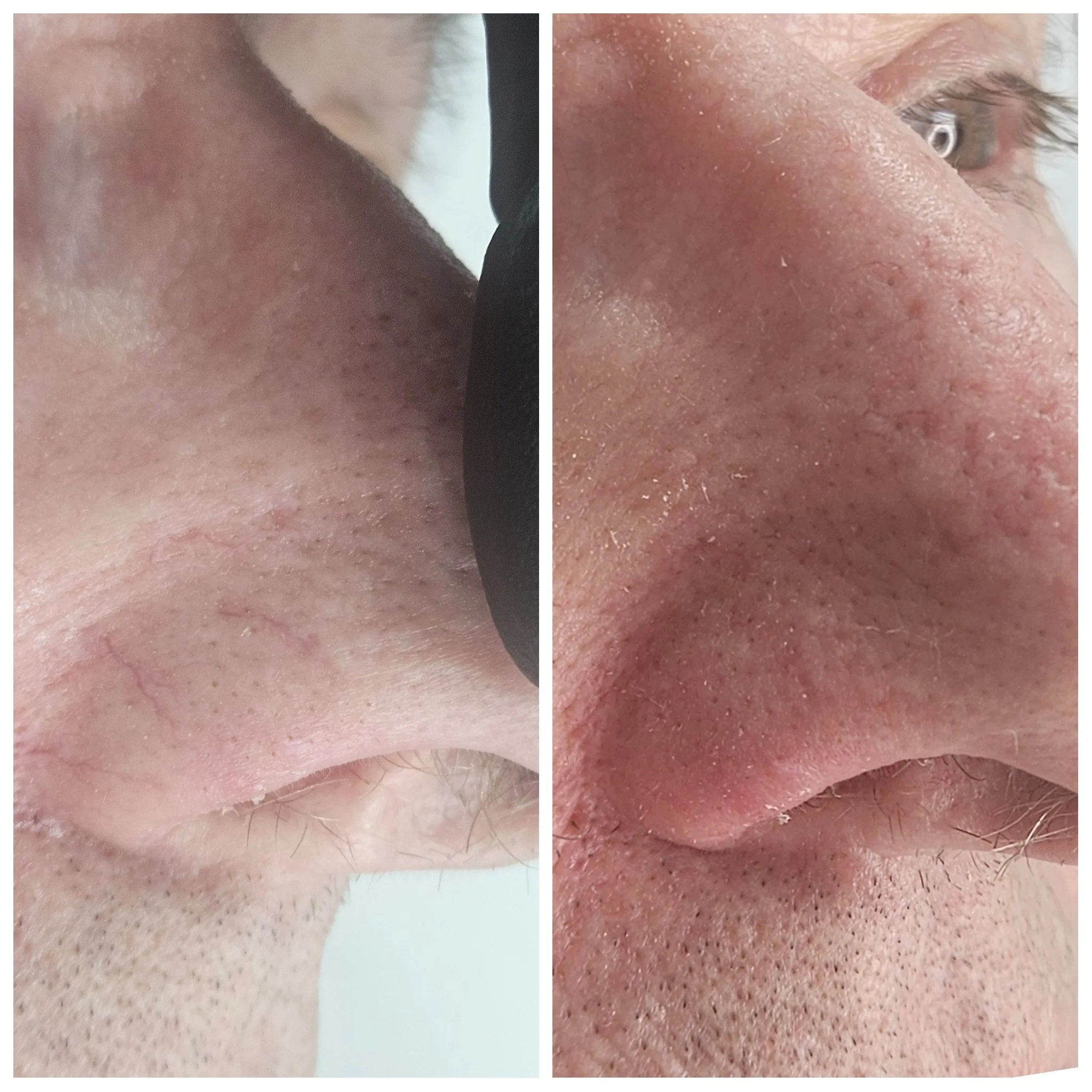 Before and After of treatment of patient's nose veins with Thermavein