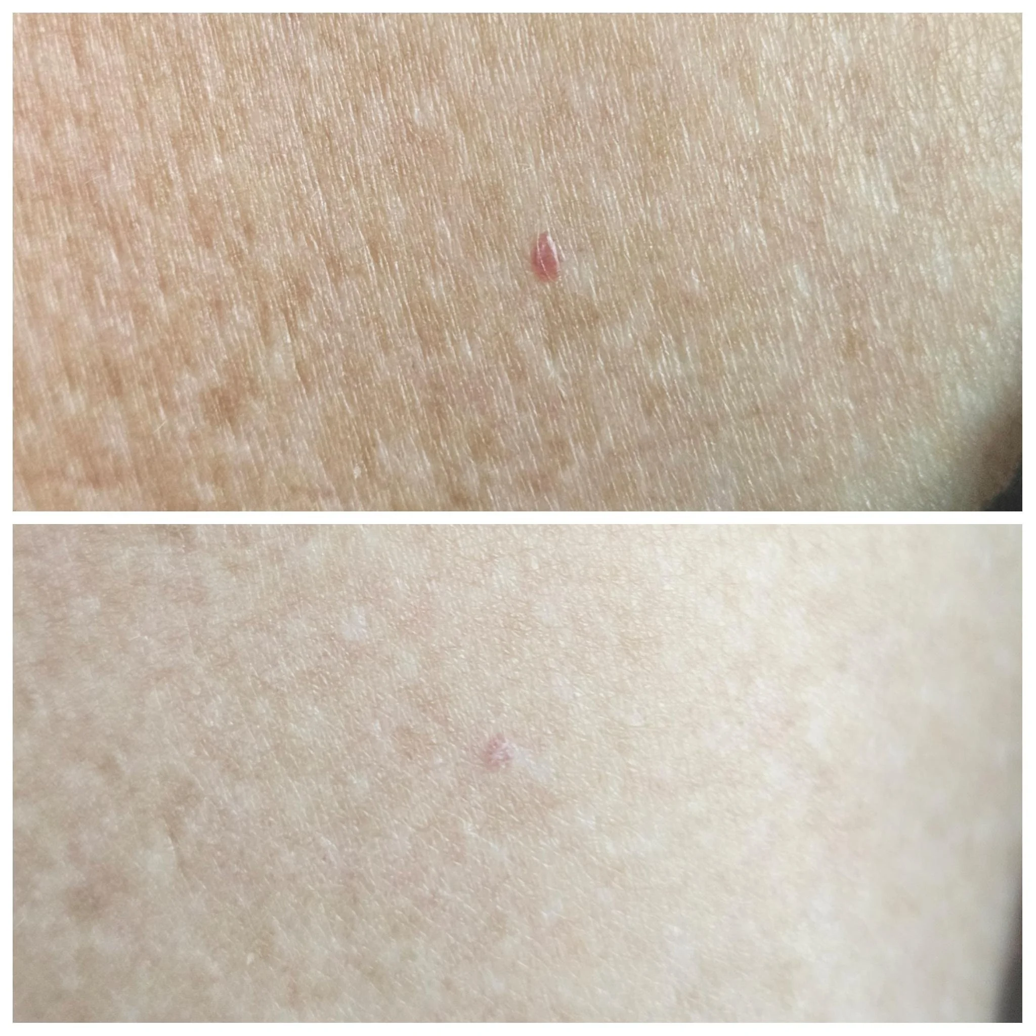 Before and after images of a patient's body showing significant reduction in cherry angioma after Thermavein treatment.