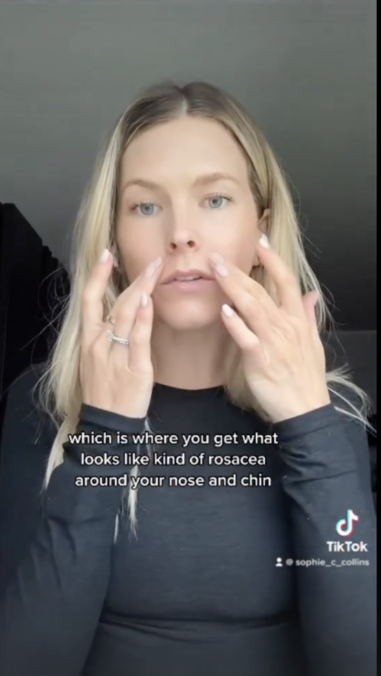 How I Healed My Perioral Dermatitis