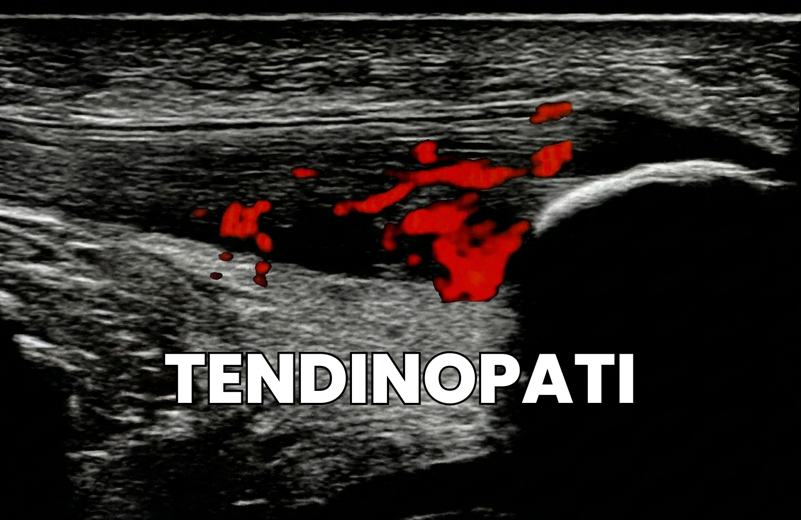 Bildet viser en sene med tendinopati. Det røde viser bevegelse av væske/blod (hyperemi) i senen. Senen fremstår fortykket (tendinose) og har degenerative forandringer.