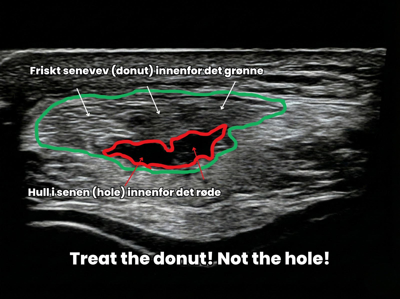 Bilde av senen under kneskjellet hvor det er “hull” i senen. Dette illustrer friskt senevev som en smultring eller donut, hvor det skadde vevet er hullet i smultringen. Bildet er fremstilt ved bruk av ultralydapparat.