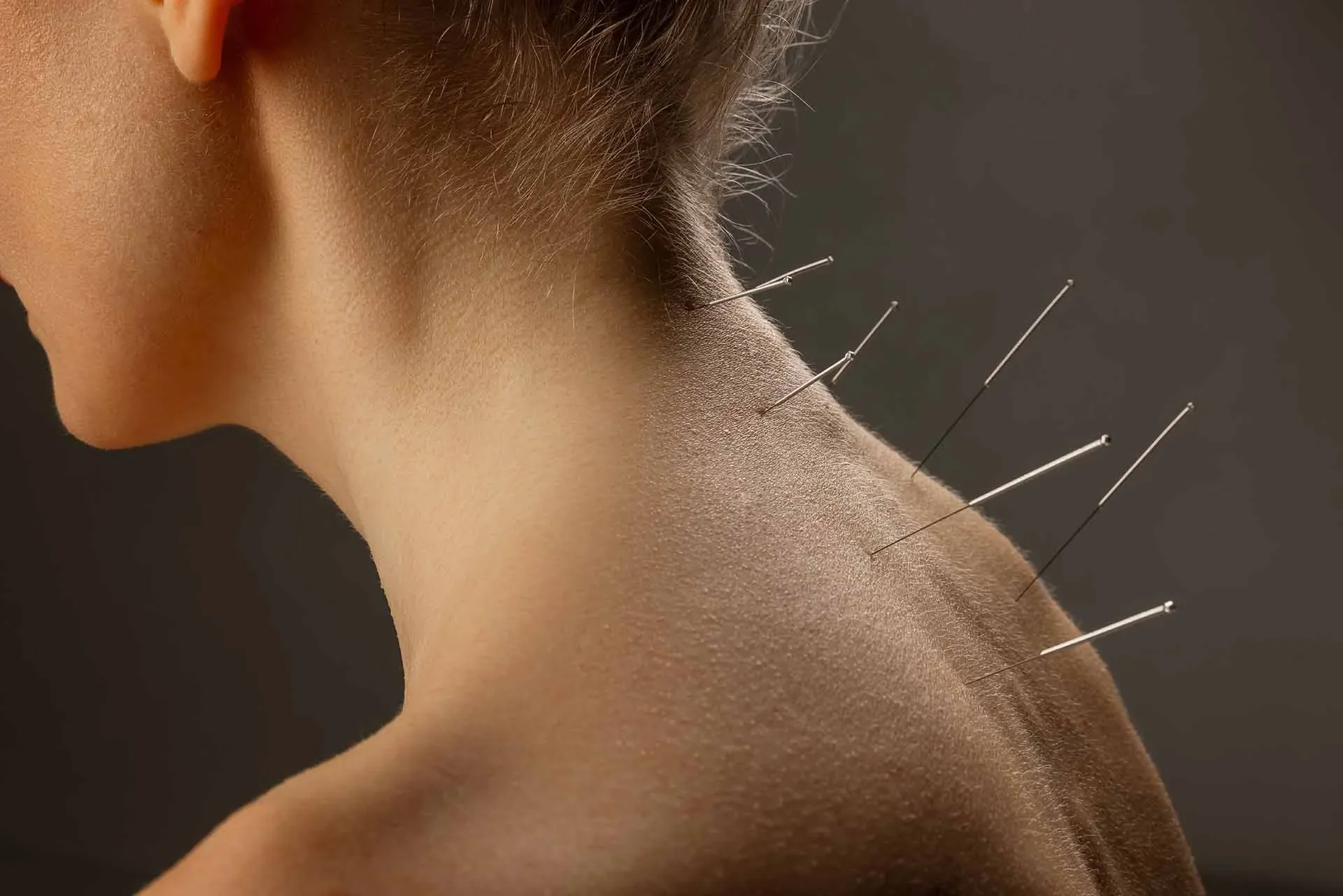 Can Acupuncture or Dry Needling Help Neck Pain?