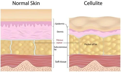 Foam Rolling for Cellulite: What It Can and Can’t Do