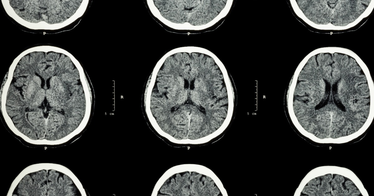 What Spanking Actually Does to a Person’s Brain